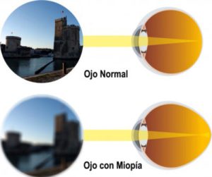 Representación gráfica de la morfología y visión de un ojo normal y un ojo miope.