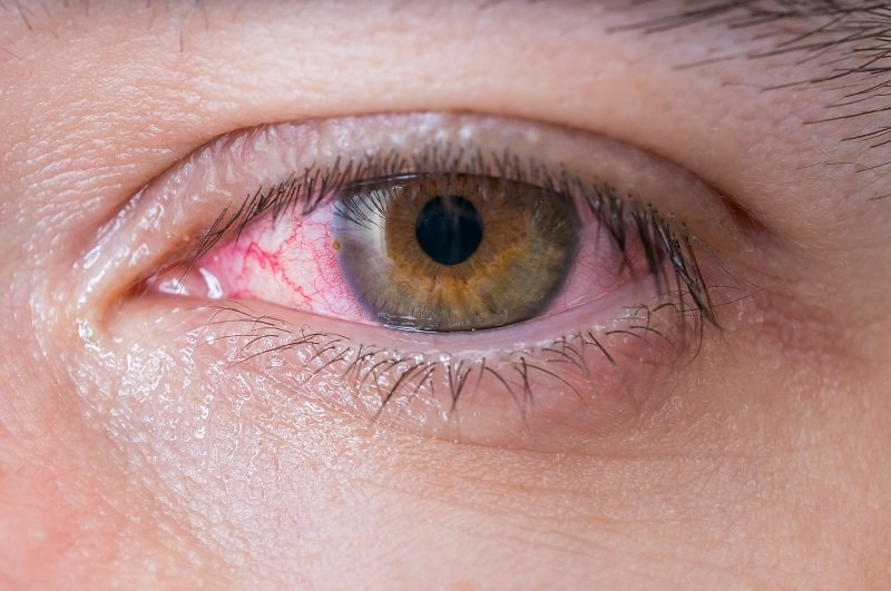 ojo seco