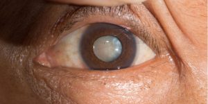 ojo humano con catarata